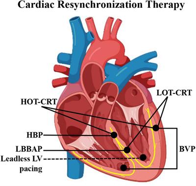 Alternative pacing strategies for optimal cardiac resynchronization therapy